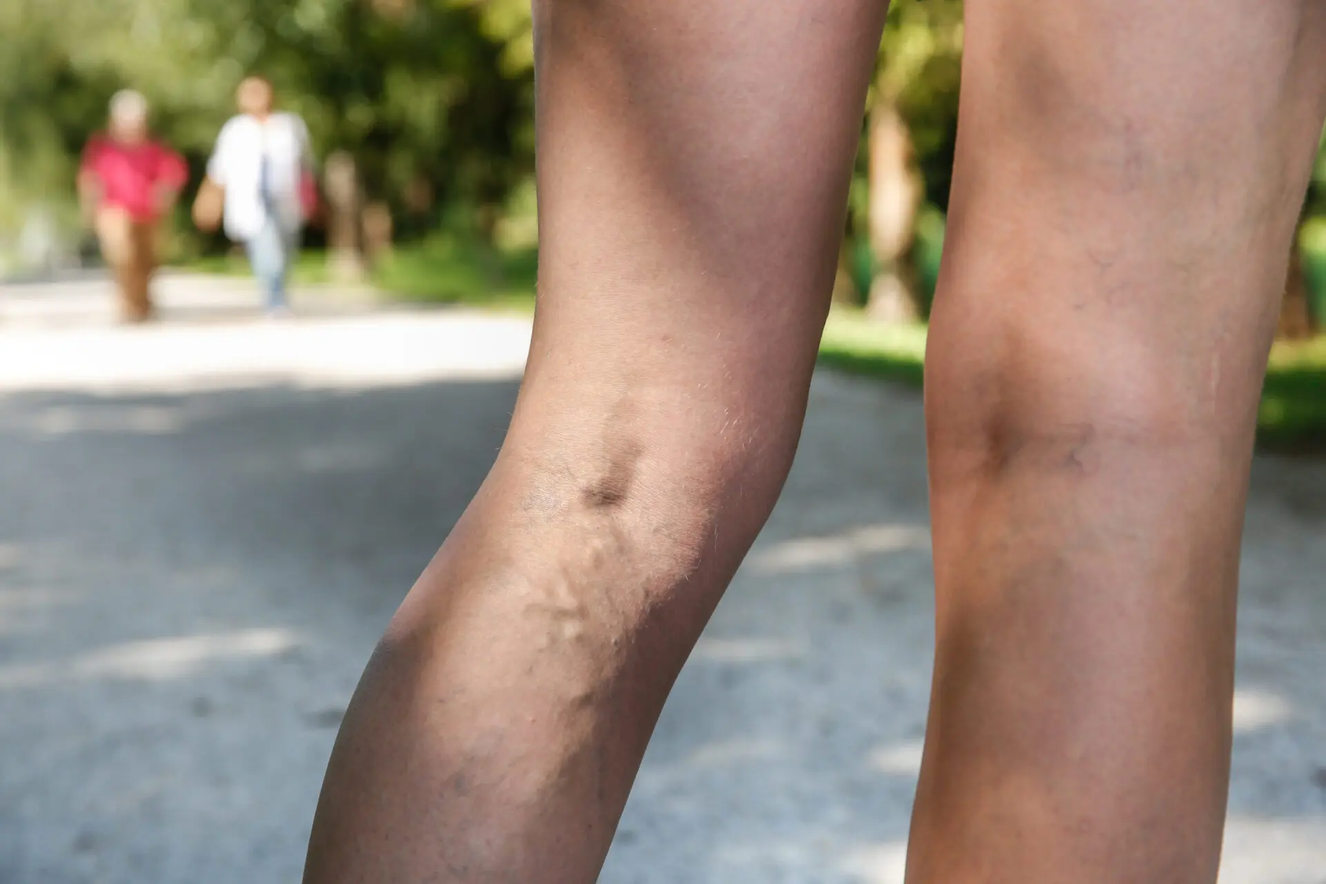 Varicose veins: When to worry and why