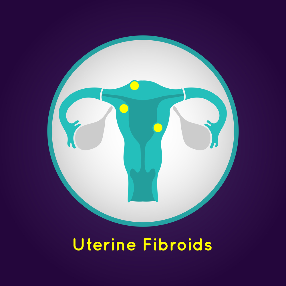 embolization and fibroids